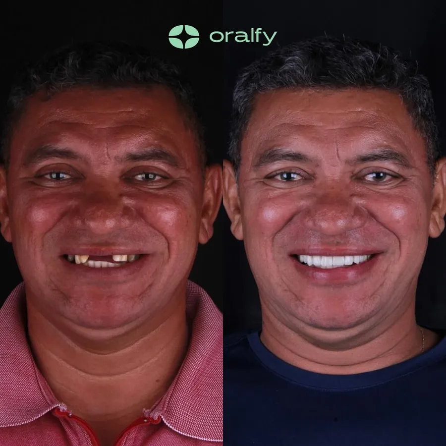 Paciente da Oralfy Teresina antes e depois do tratamento