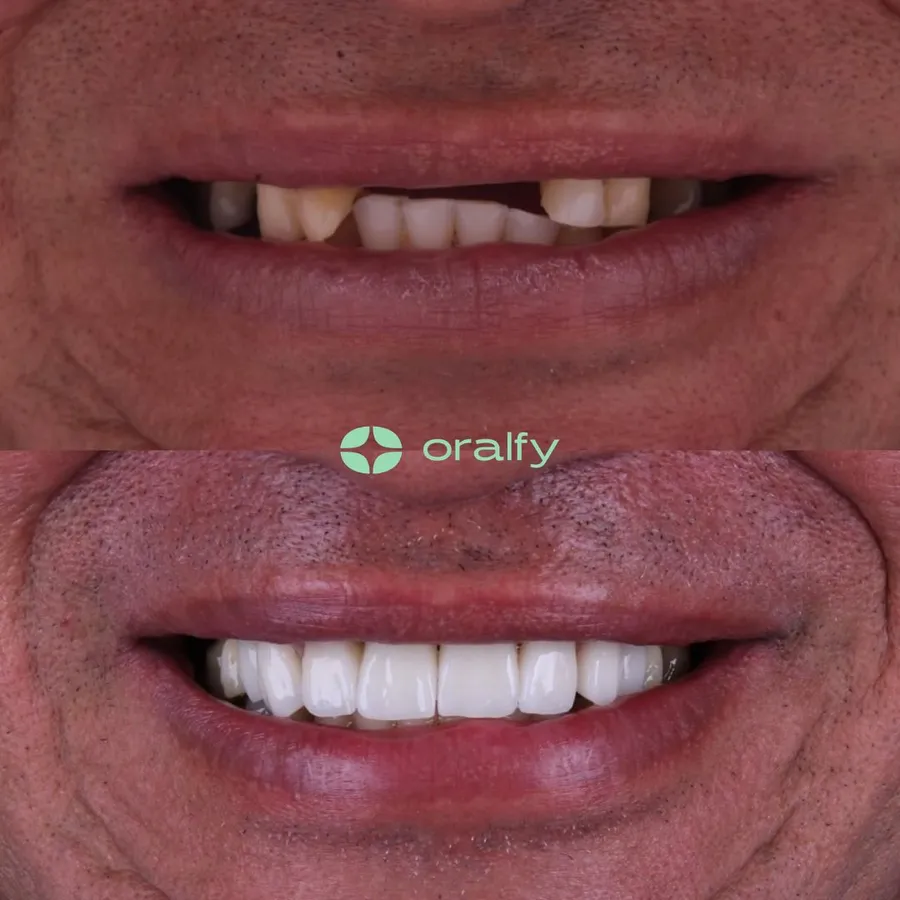 Paciente da Oralfy Teresina antes e depois do tratamento
