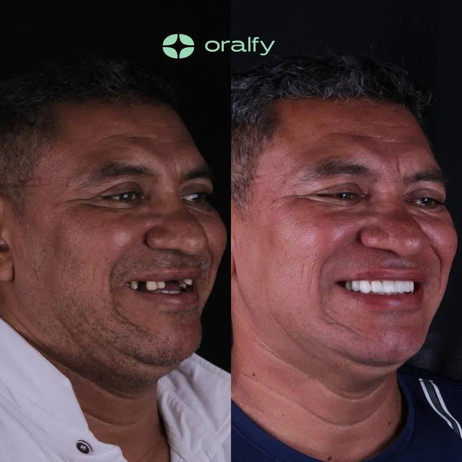 Paciente da Oralfy Teresina antes e depois do tratamento