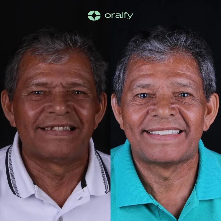Paciente da Oralfy Teresina antes e depois do tratamento