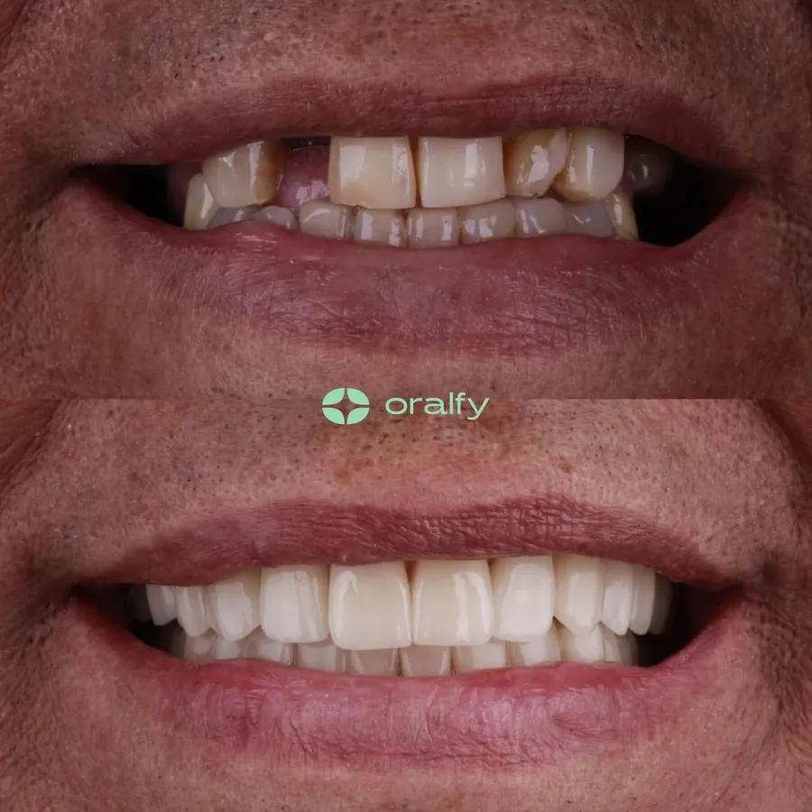 Paciente da Oralfy Teresina antes e depois do tratamento