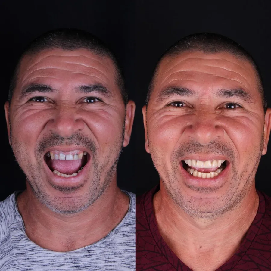 Paciente da Oralfy Teresina antes e depois do tratamento