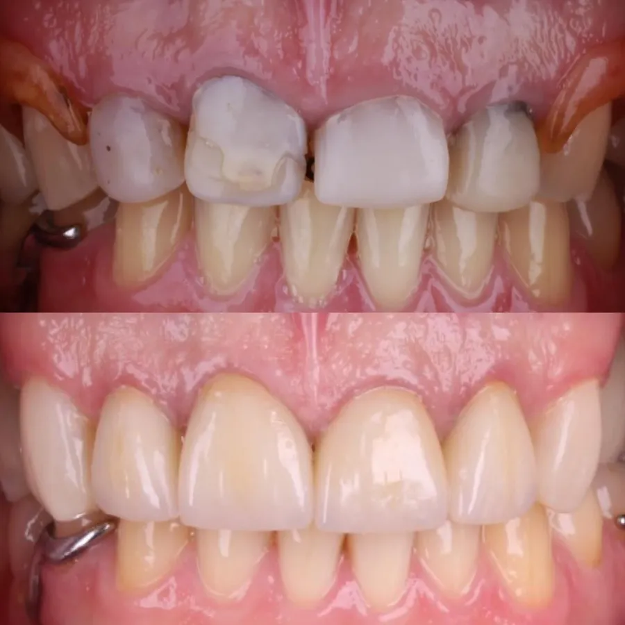 Paciente da Oralfy Teresina antes e depois do tratamento