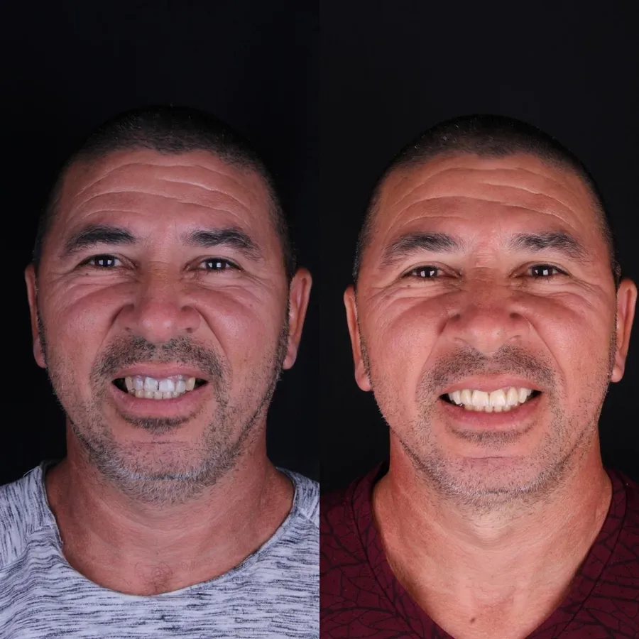Paciente da Oralfy Teresina antes e depois do tratamento