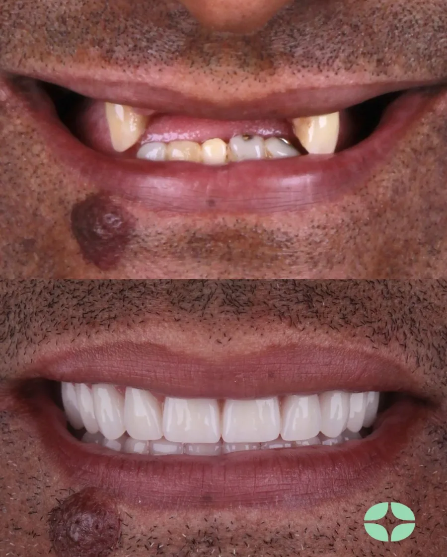 Paciente da Oralfy Teresina antes e depois da reabilitação com dentes fixos