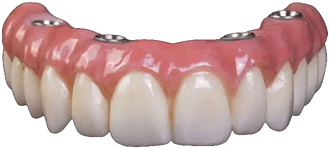 Prótese protocolo de dentes fixos, parafusada sobre implantes